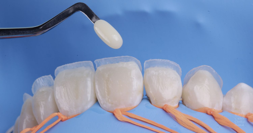 Carillas de composite o porcelana: ¿cuál es mejor para tu sonrisa?