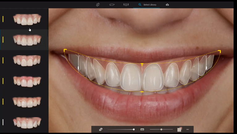 ¿Cuántas carillas necesito para mejorar mi sonrisa: 2, 4, 6, 8 o 10?