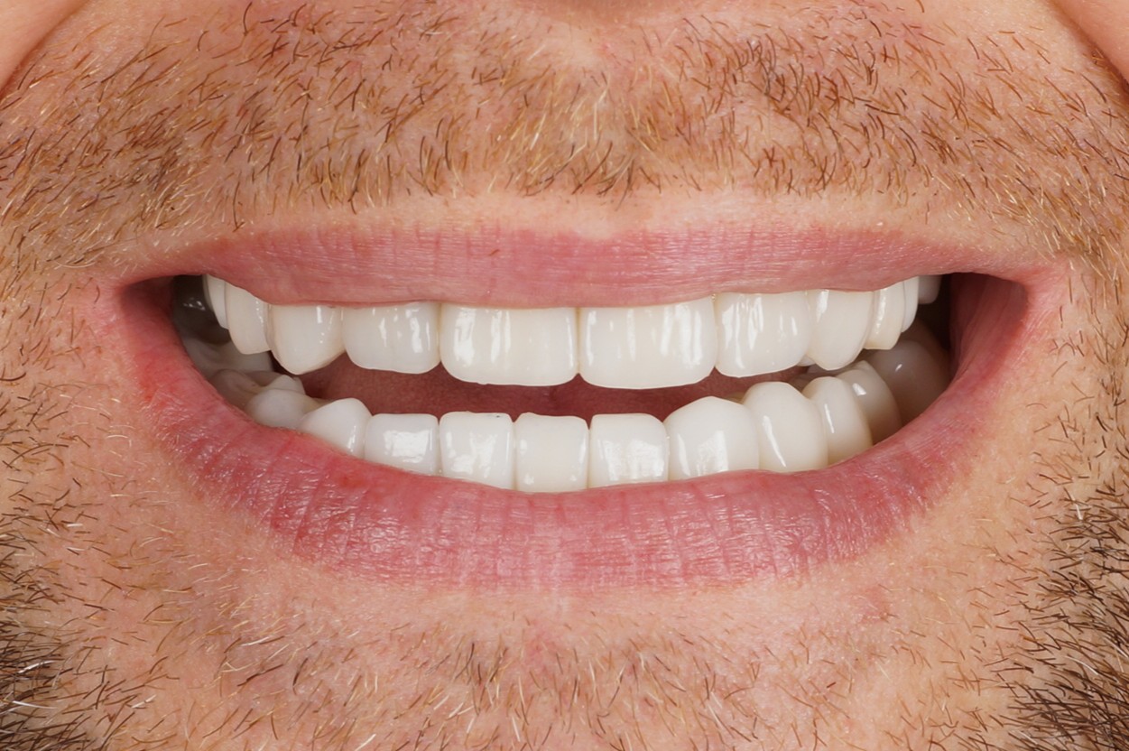 Invisalign and full mouth rehabilitation with zirconian crowns and onlays - After