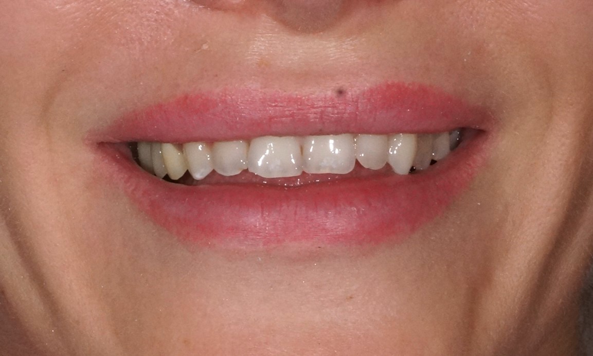 Philips Zoom whitening + 4 upper composite veneers + posterior zirconia crowns and overlays - Before