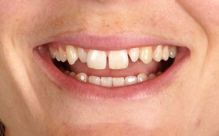 Invisalign express + Philips Zoom whitening +2 lateral emax porcelain veneers  - Before