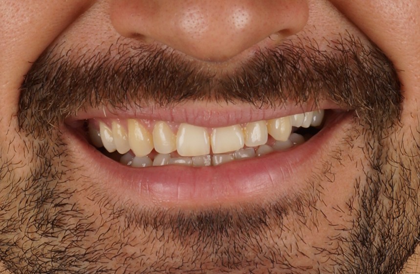 mock up dental