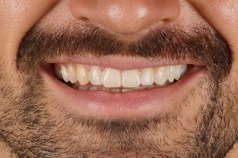 Mock up of 8 upper teeth with aesthetic resin - After