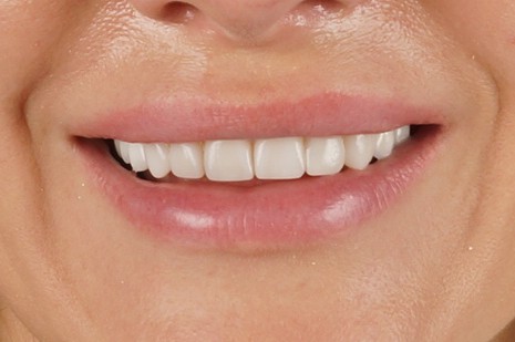 Philips Zoom whitening + 4 upper composite veneers + posterior zirconia crowns and overlays - After
