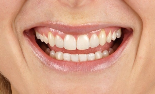 Invisalign express + Philips Zoom whitening +2 lateral emax porcelain veneers  - After