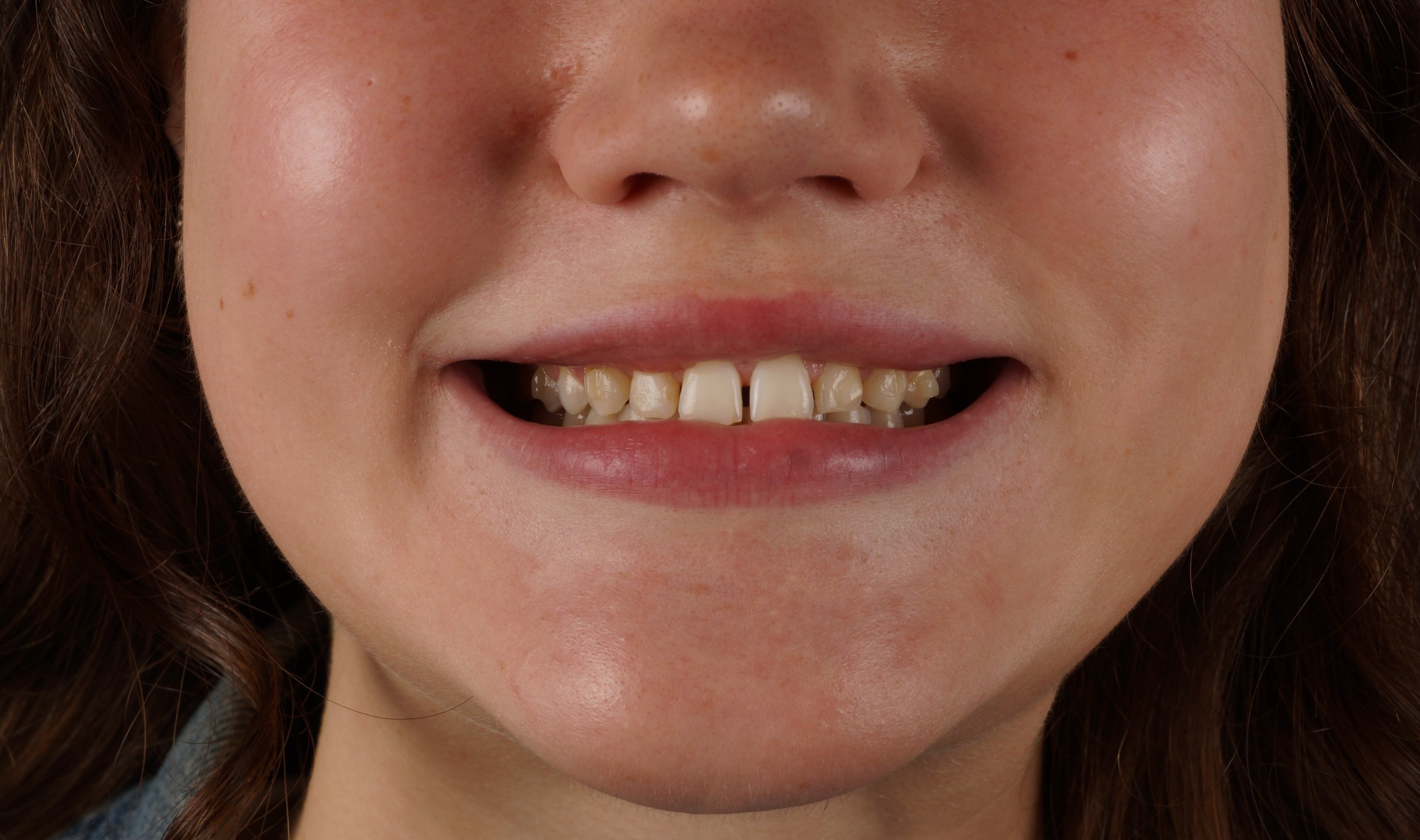 Philips Zoom Whitening + 10 composite veneers - Before