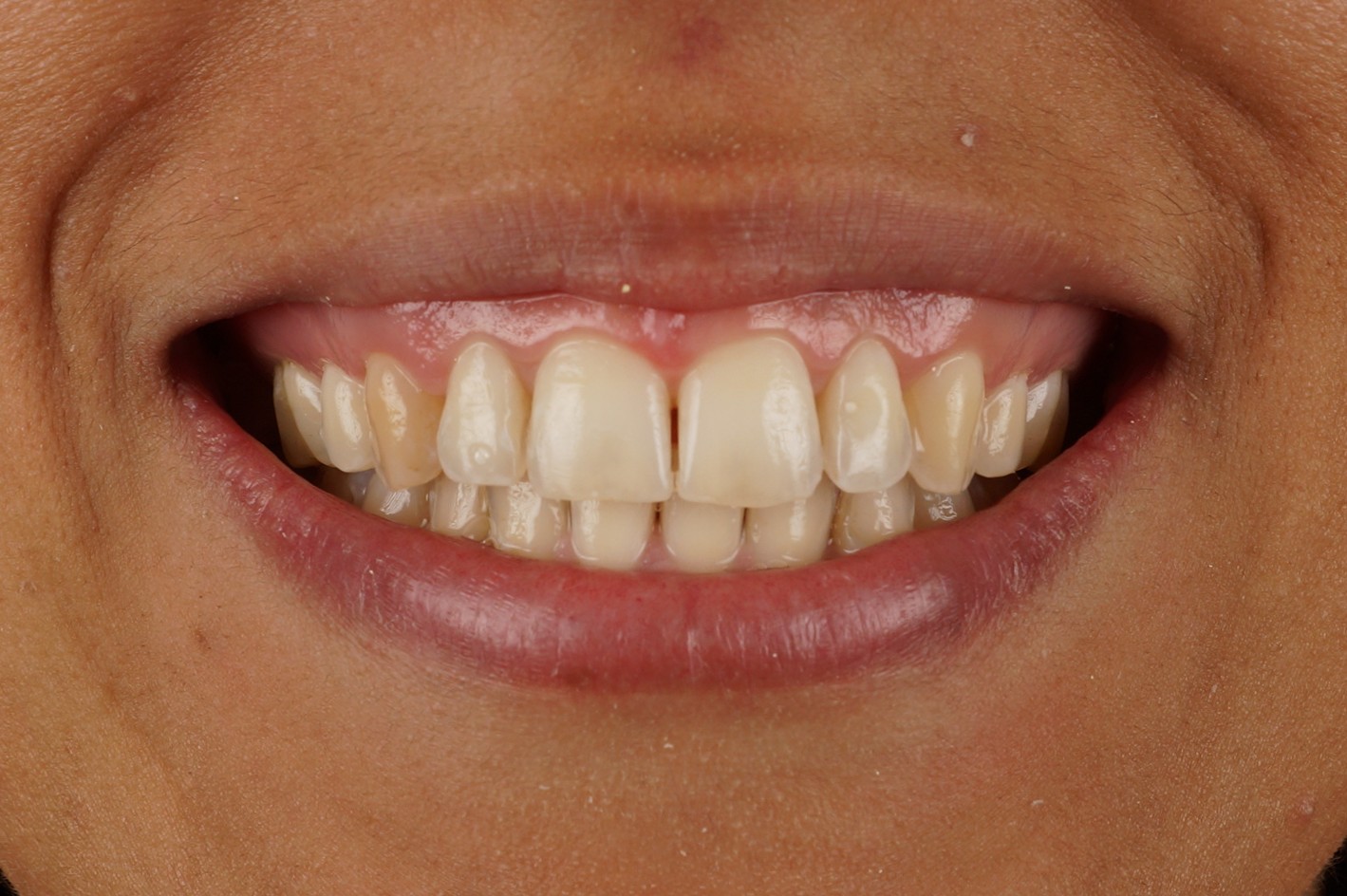 Philips Zoom whitening + 2 aesthetic composite reconstructions - Before