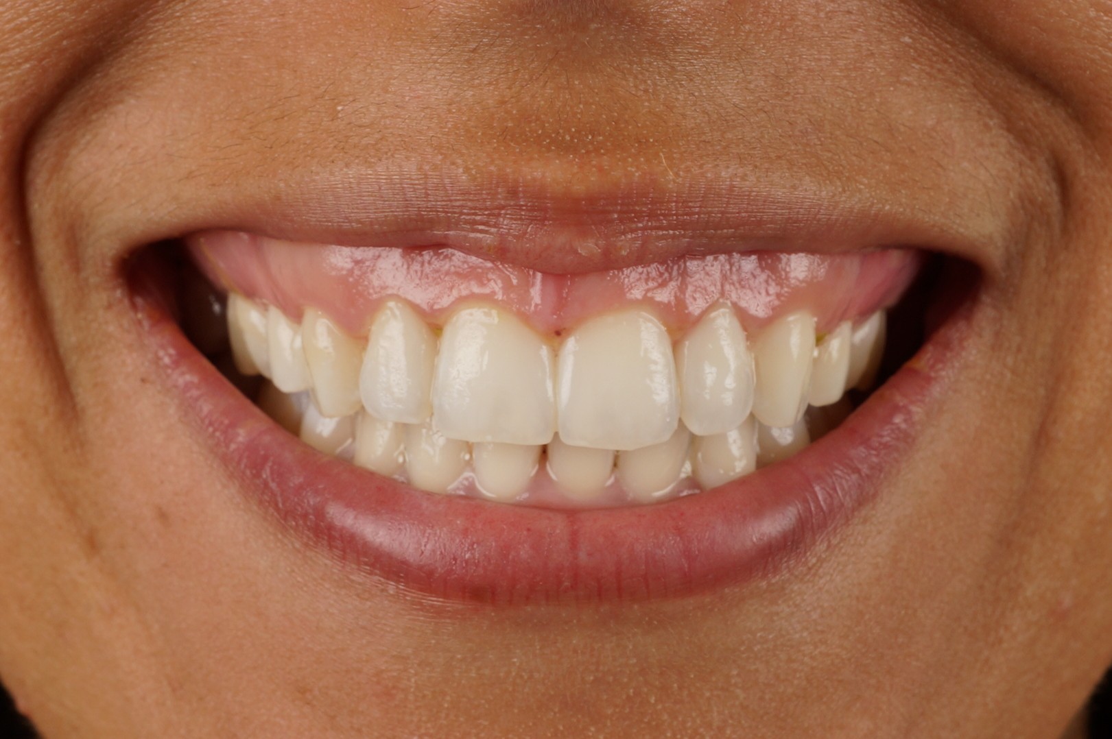 Philips Zoom whitening + 2 aesthetic composite reconstructions - After