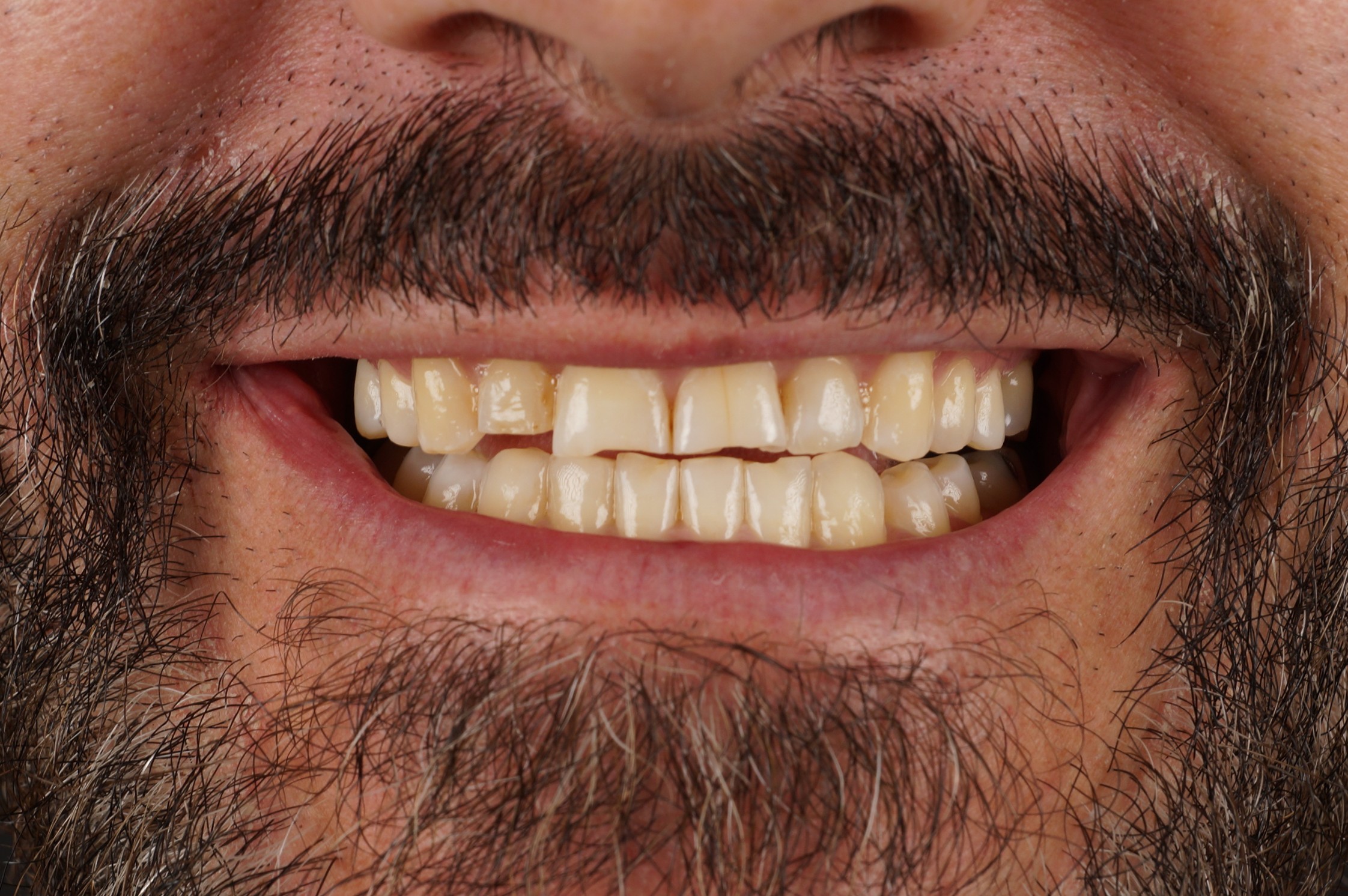 Philips Zoom whitening + 4 aesthetic composite reconstructions - Before