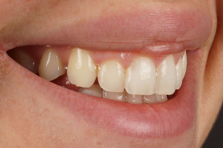 Philips Zoom Whitening + aesthetic composite reconstruccions - Before