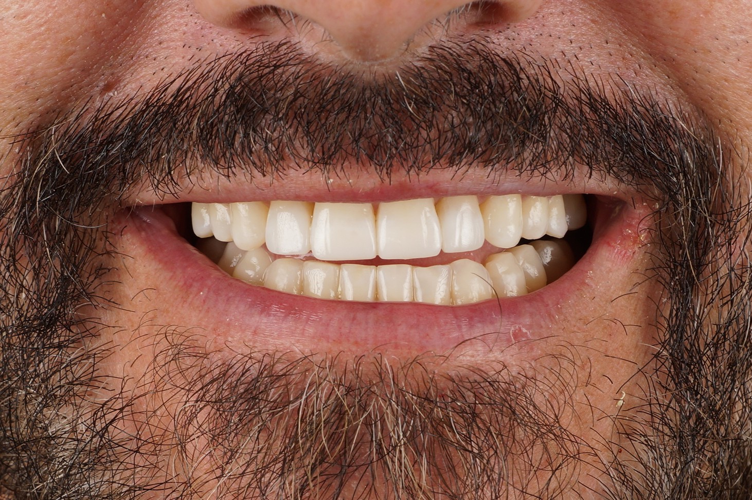 Philips Zoom whitening + 4 aesthetic composite reconstructions - After