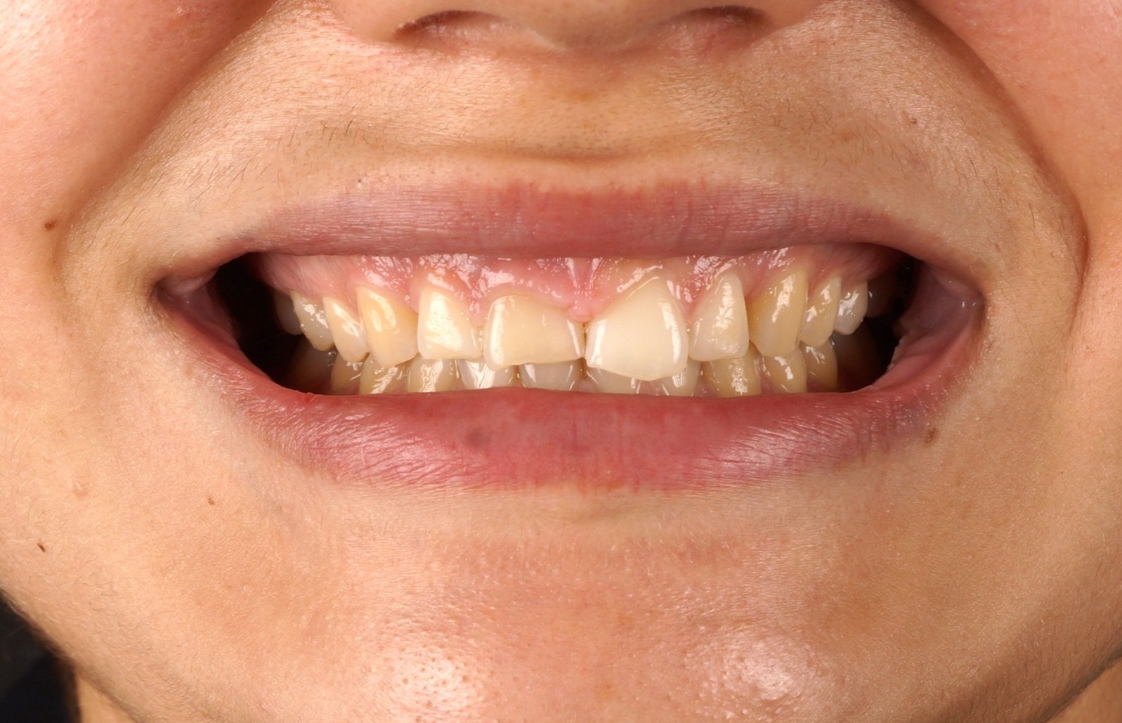 Gum correction (surgical crown lengthening) + Philips Zoom Whitening & 6 front composite veneers/reconstruccions - Before