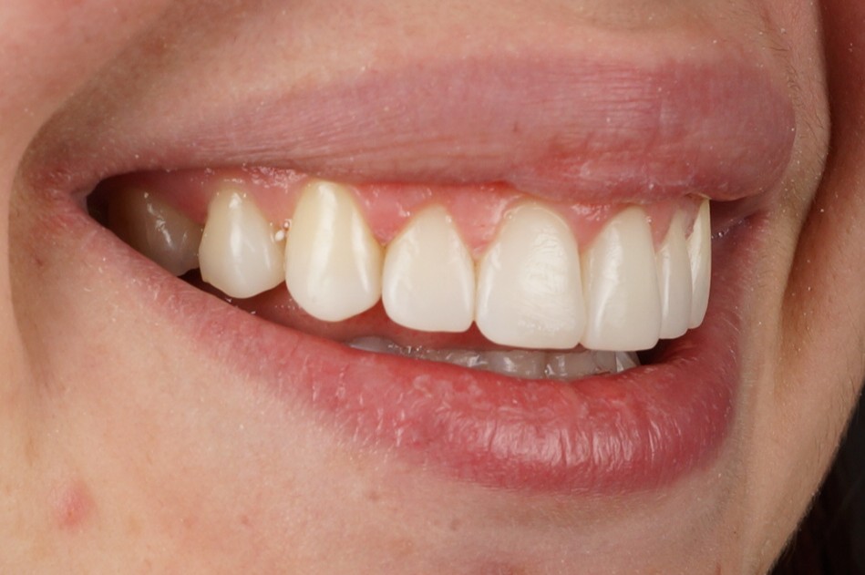Philips Zoom Whitening + aesthetic composite reconstruccions - After