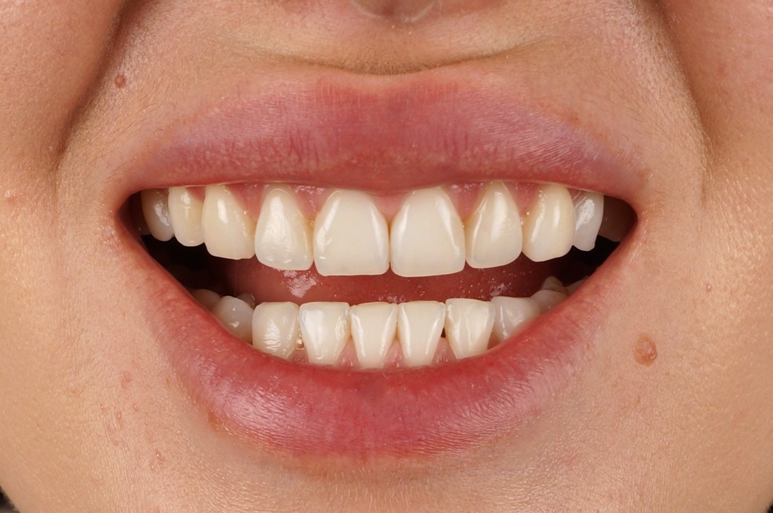 Philips Zoom Whitening & 4 front composite veneers - Before