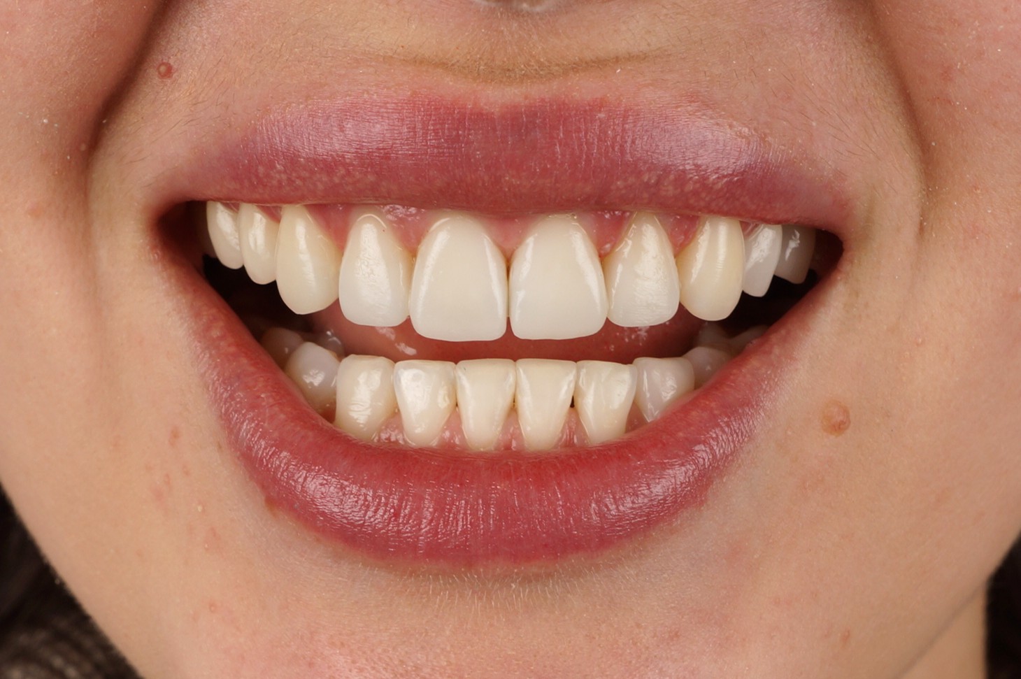 Philips Zoom Whitening & 4 front composite veneers - After