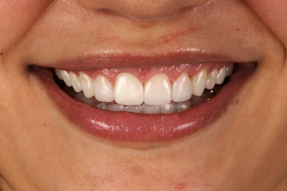 Gum correction (surgical crown lengthening) + Philips Zoom Whitening & 6 front composite veneers/reconstruccions - After