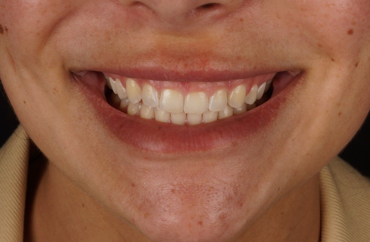 Gum correction upper arch + Philips Zoom whitening + 6 aesthetic composite reconstructions - Before