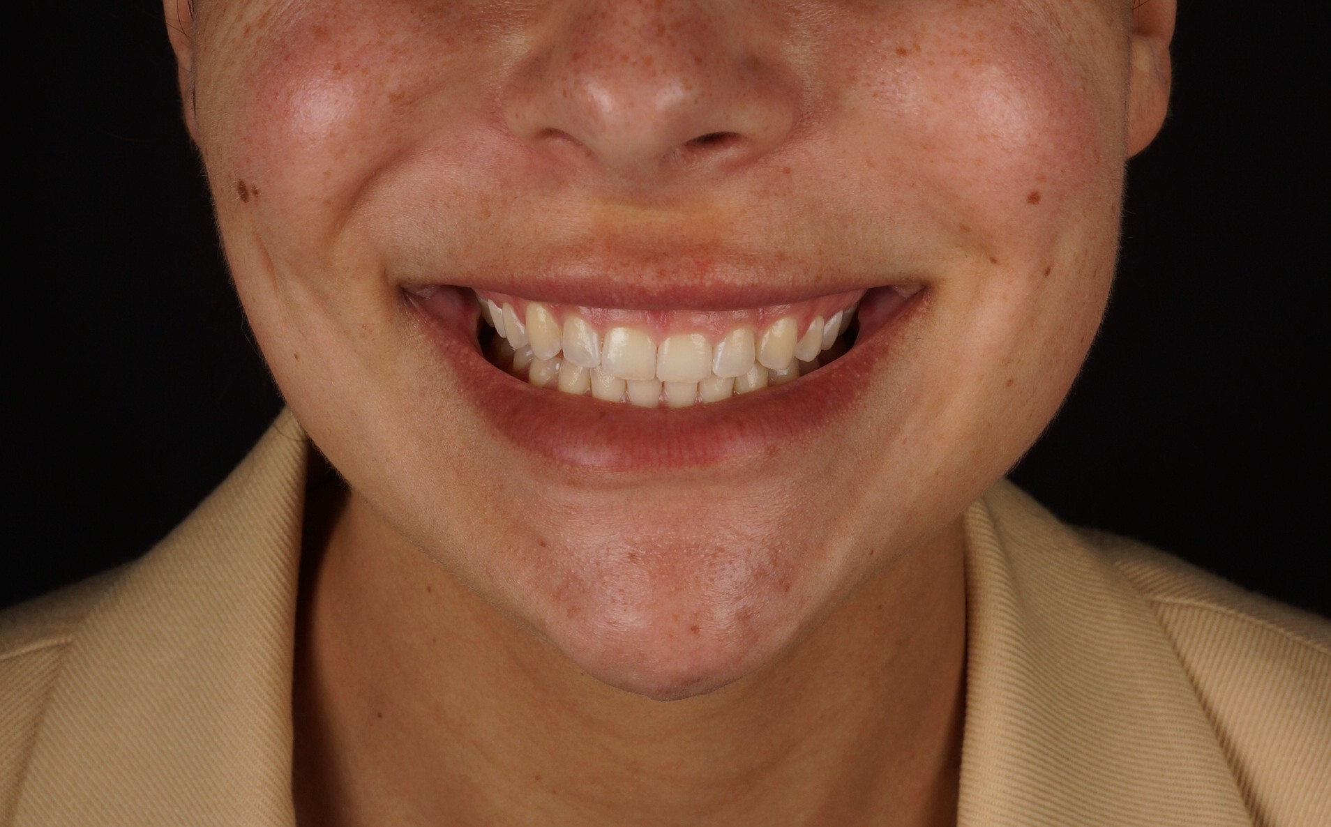 sonrisa gingival tratamiento barcelona