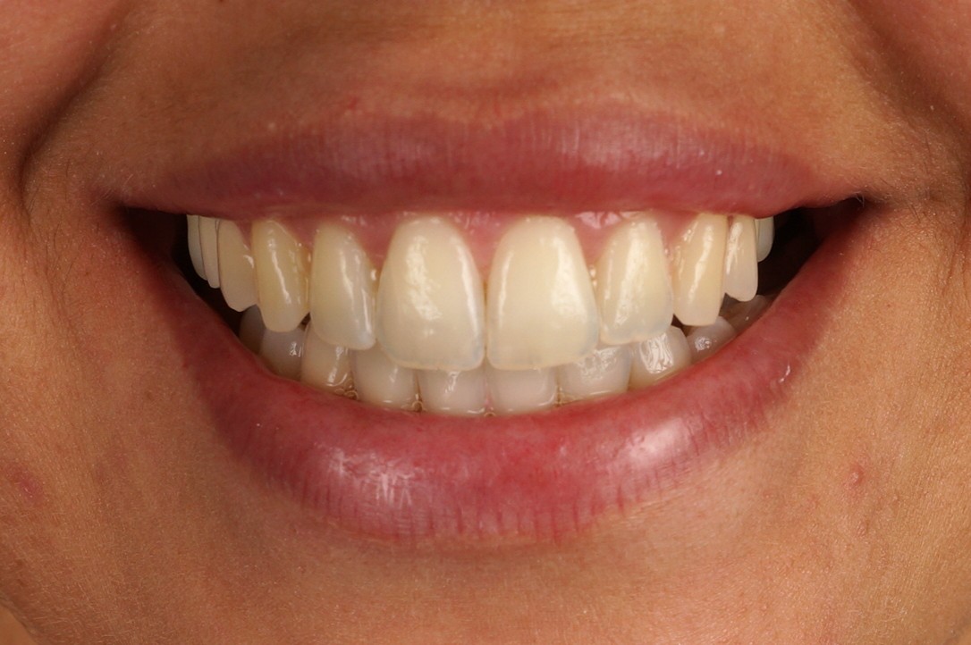 Philips Zoom Whitening & 4 incisors aesthetic reconstructions recontouring the shape  - Before