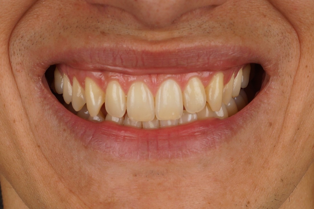 Philips Zoom Whitening & 4 aesthetic composite restorations for incisal borders - Before