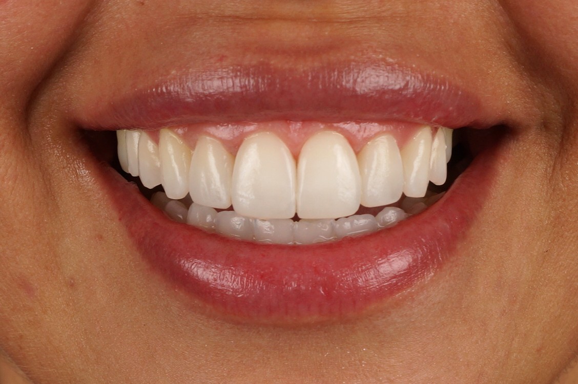 Philips Zoom Whitening & 4 incisors aesthetic reconstructions recontouring the shape  - After