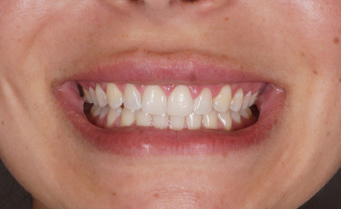sonrisa gingival
