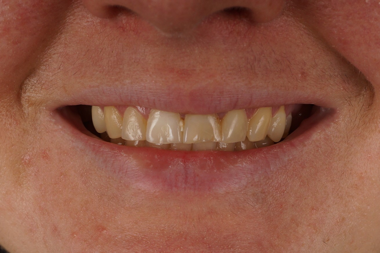 Blanqueamiento Philips Zoom y 2 reconstrucciones en incisivos superiores sin tallado - Before