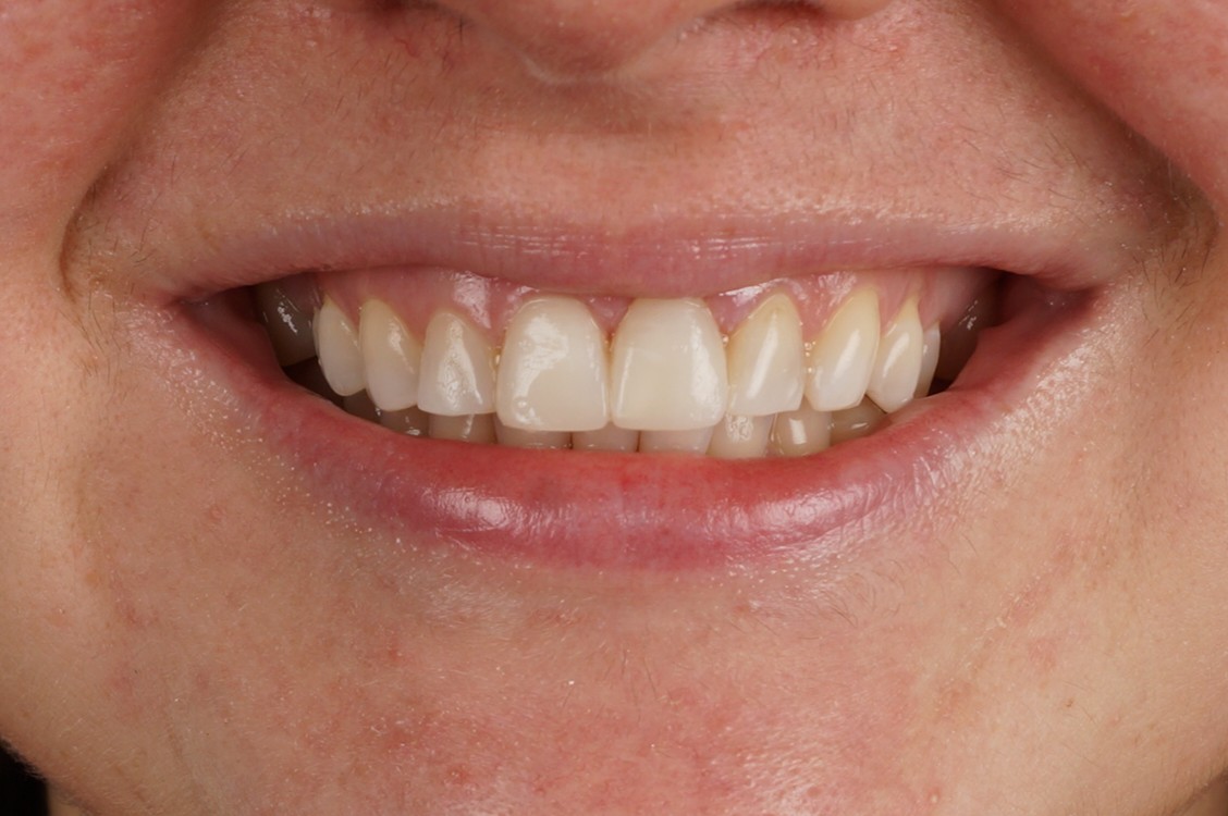 Blanqueamiento Philips Zoom y 2 reconstrucciones en incisivos superiores sin tallado - After