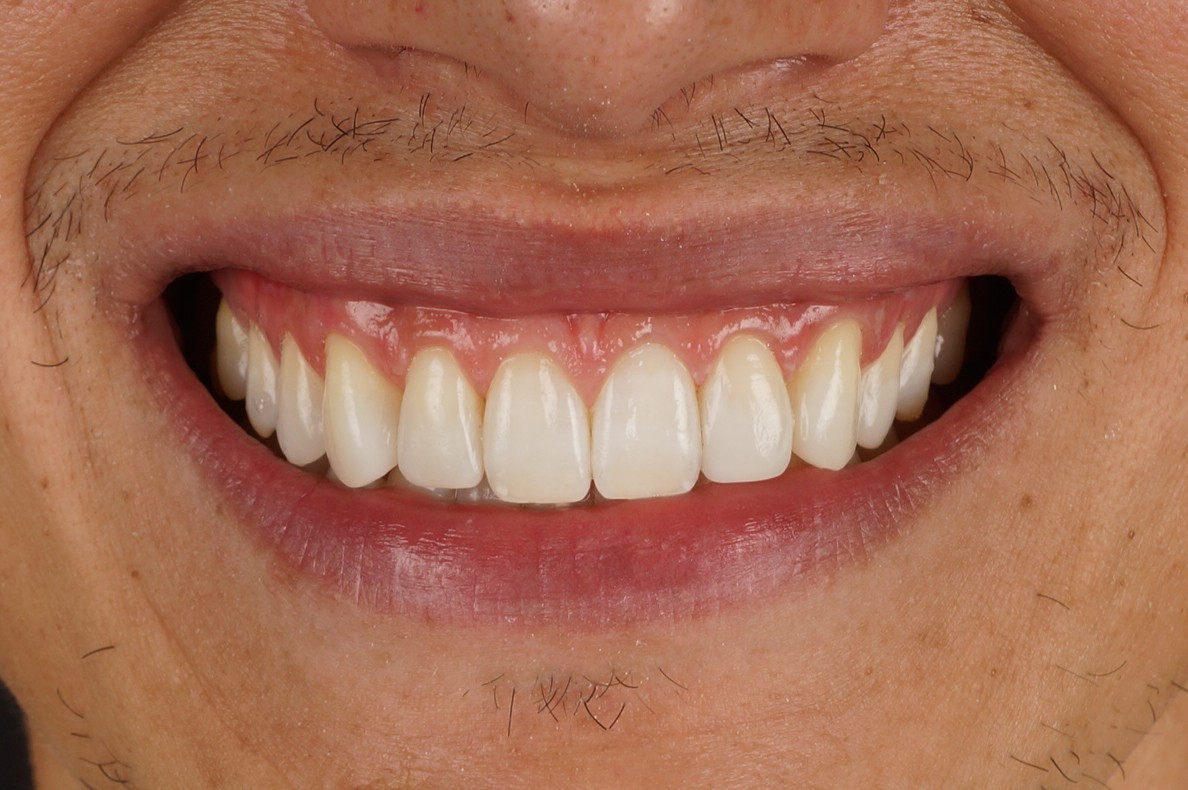 Philips Zoom Whitening & 4 aesthetic composite restorations for incisal borders - After
