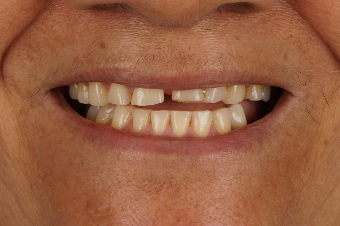 Philips Zoom Whitening & 6 composite veneers - Before
