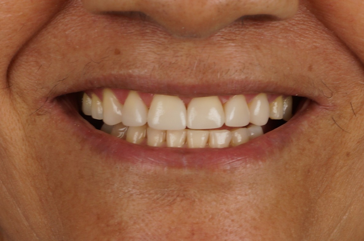 Philips Zoom Whitening & 6 composite veneers - After