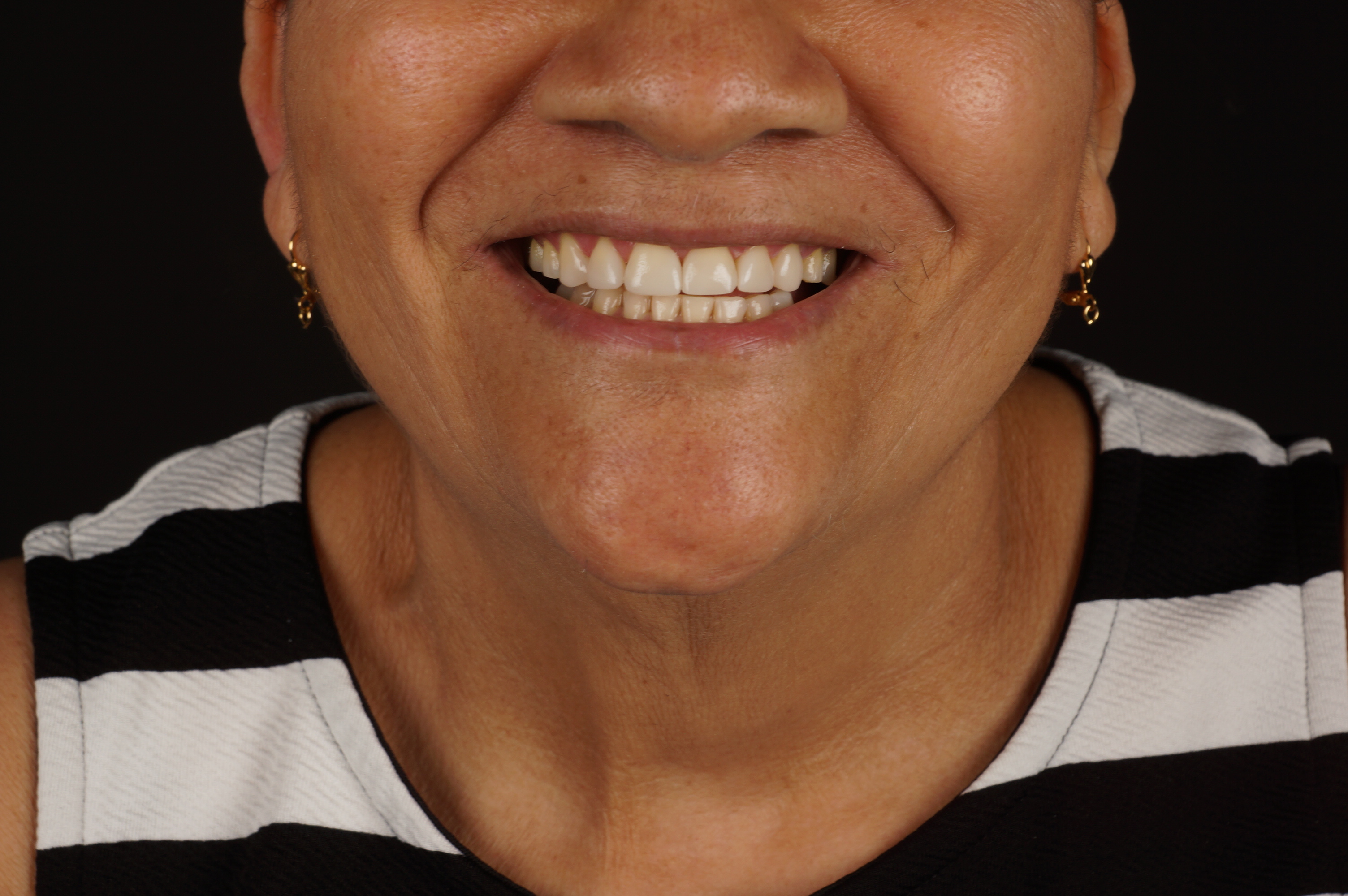 Odontología mínimamente invasiva y diseño de sonrisa en Barcelona