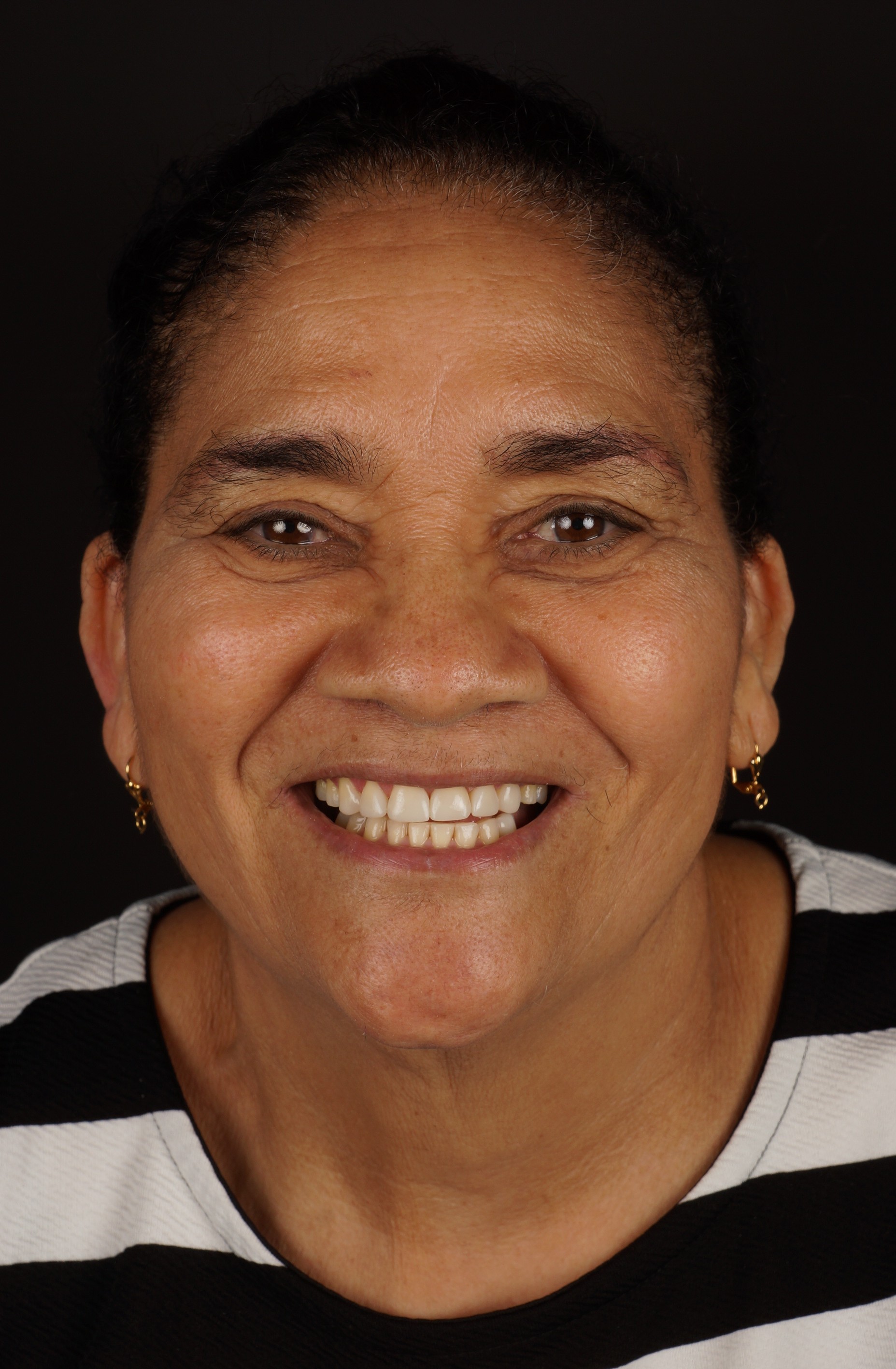 Diseño de sonrisa basado en armonía facial en SMITA Barcelona