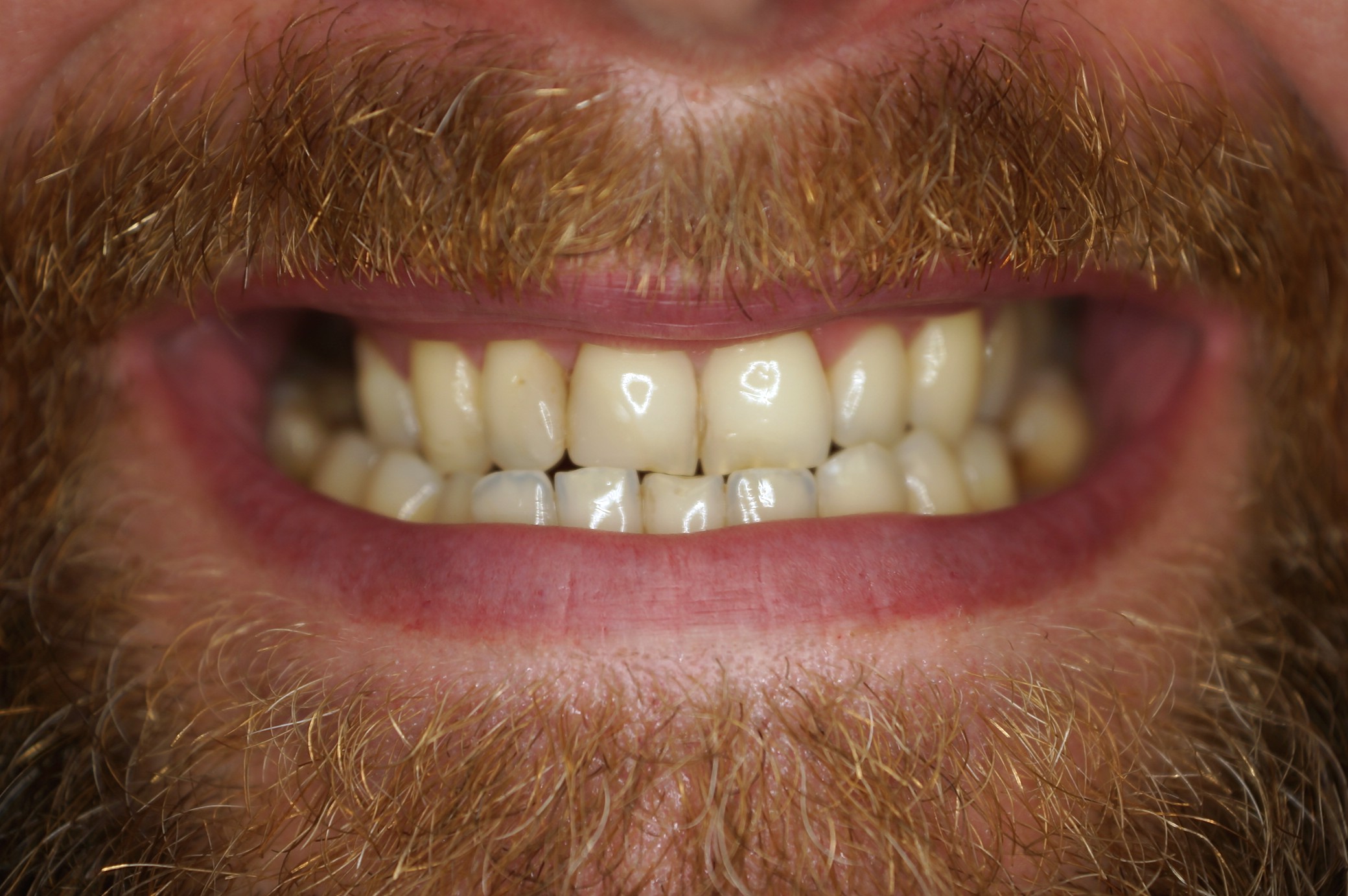 Invisalign and full mouth rehabilitation with zirconian crowns and onlays - Before