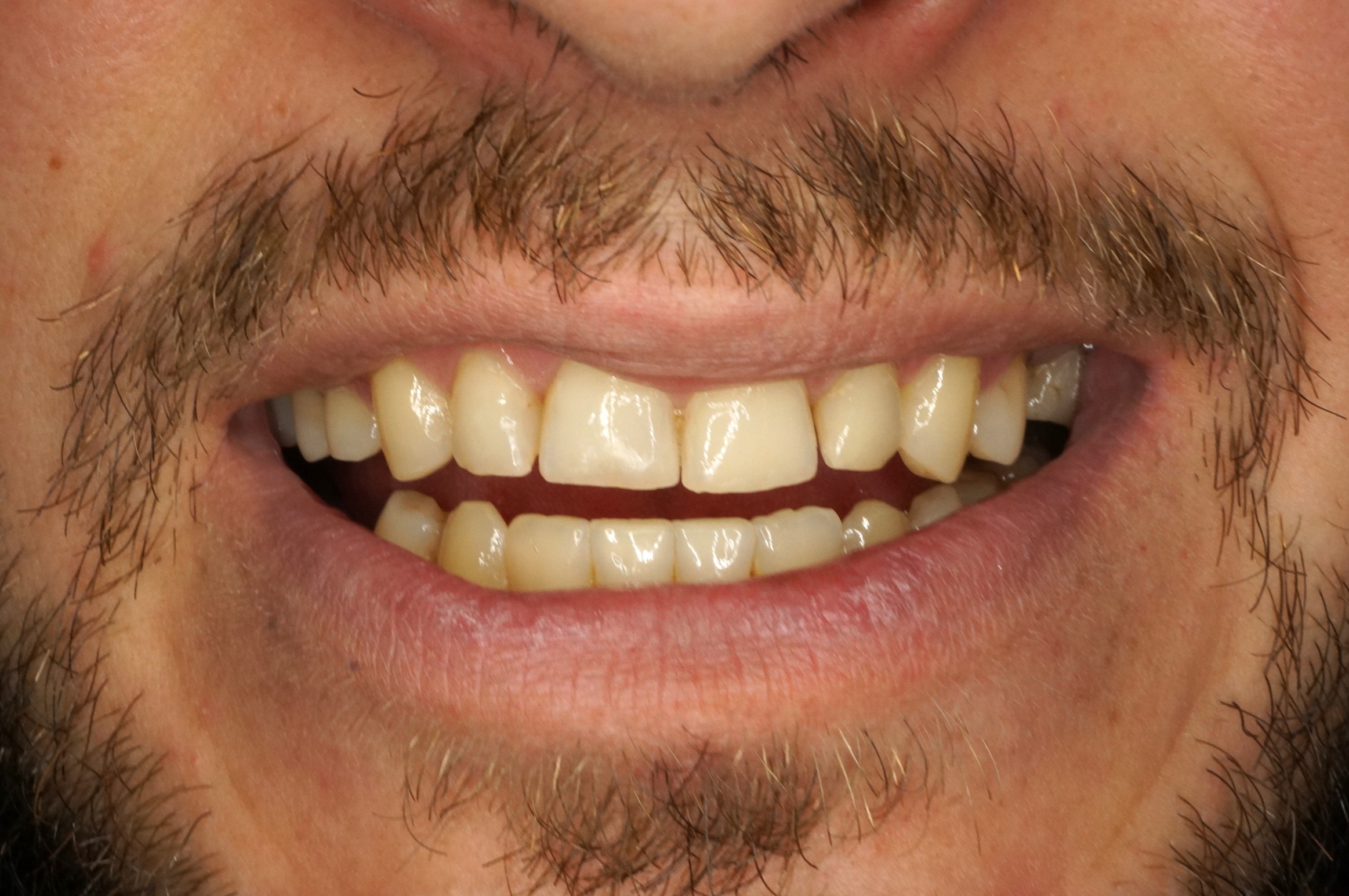 Carillas de porcelana - Before