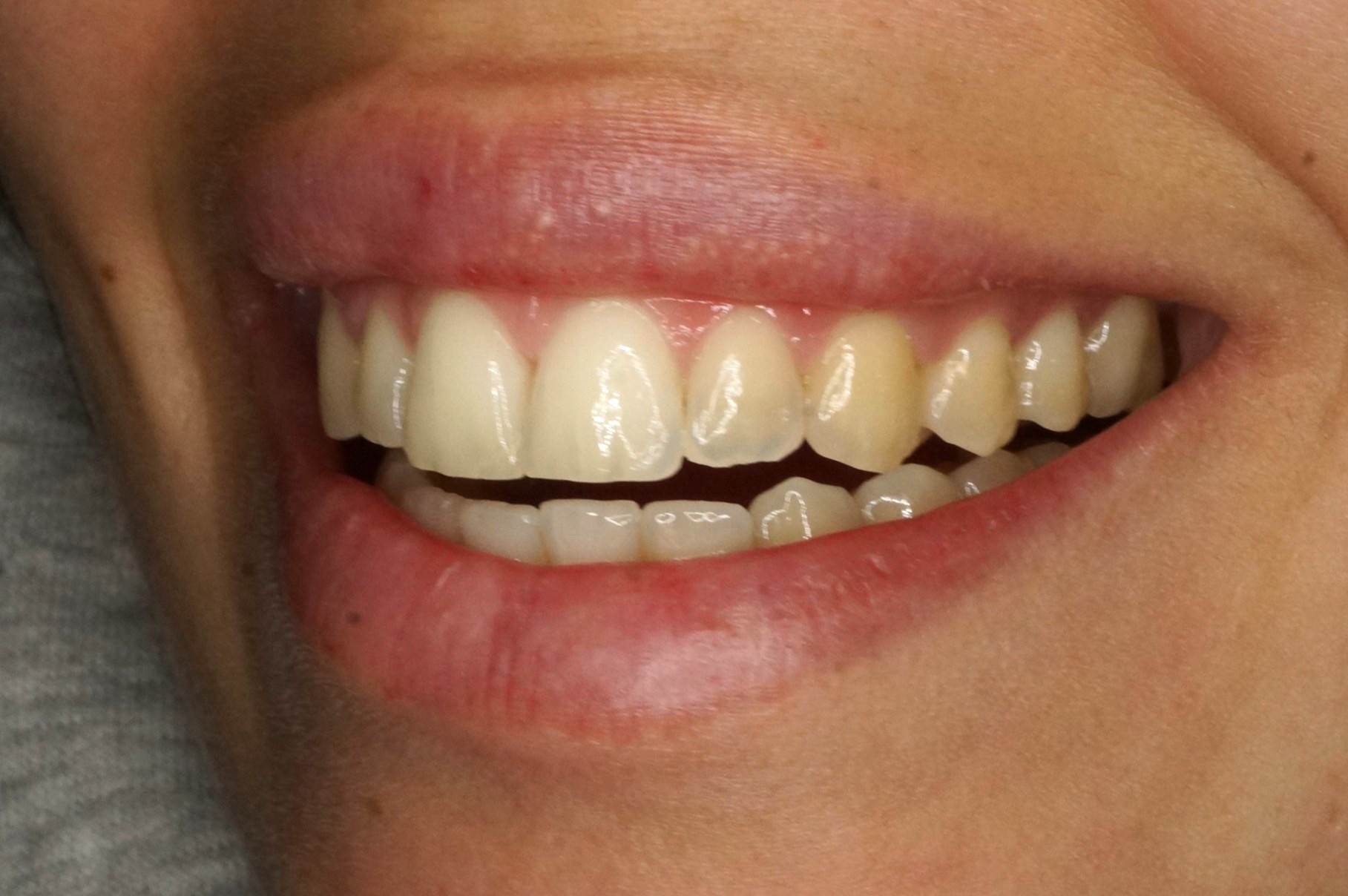 Blanqueamiento y reconstrucciones con composite - Before