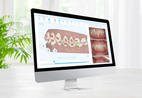 Diseño de sonrisa con Invisalign antes de tratamiento estético