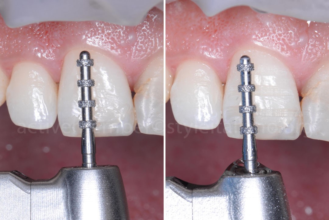 Invisalign para mejorar proporciones antes de carillas estéticas