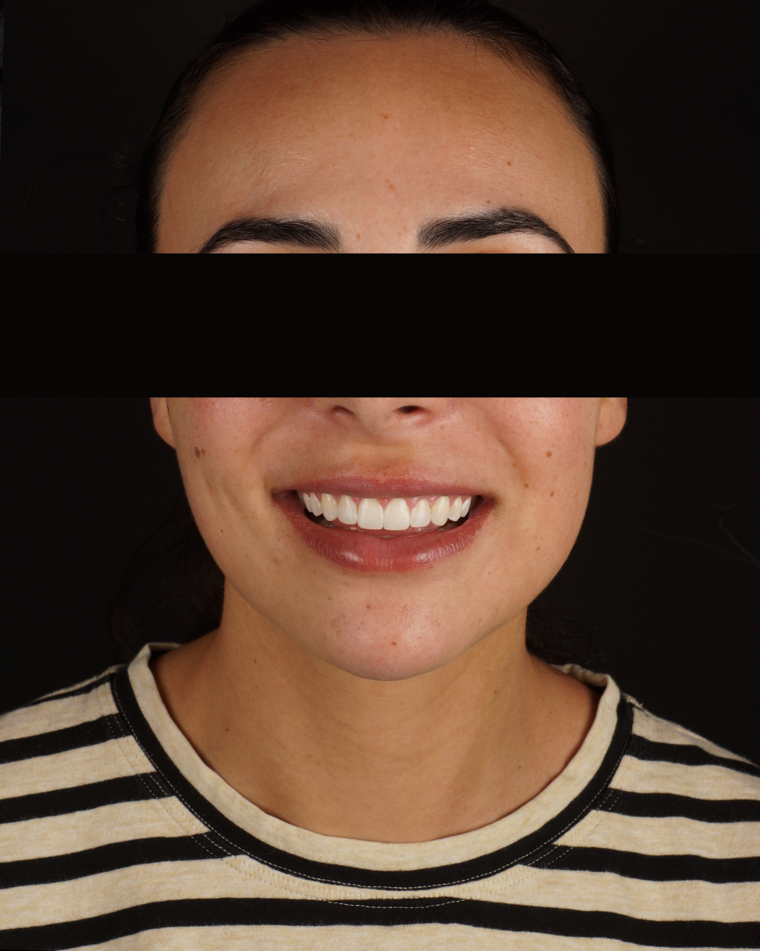 antes y despues carillas composite gingivectomia barcelona