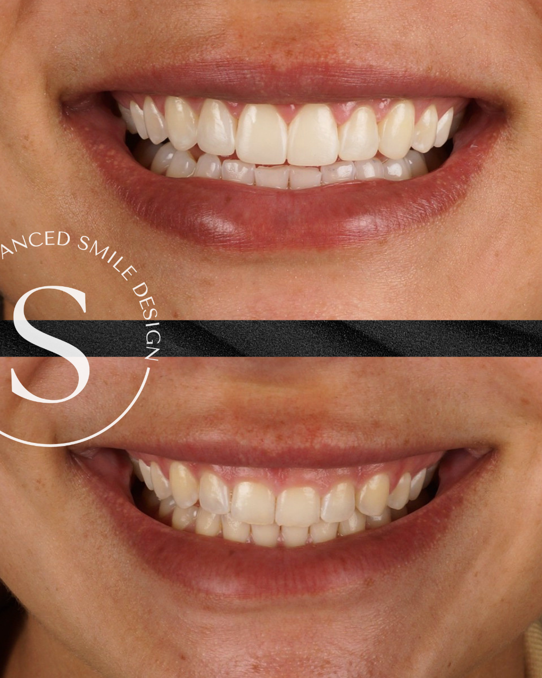 antes y despues carillas composite gingivectomia barcelona Dra Rai