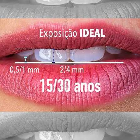 Análisis de línea de sonrisa y relación con el labio inferior