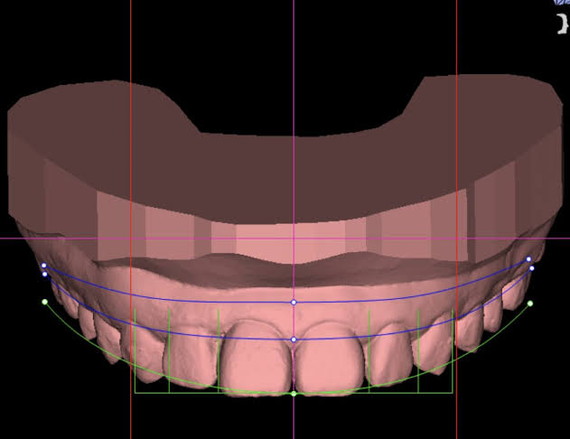 Corrección de posición dental antes de colocar carillas en Barcelona
