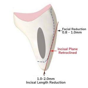preparacion para carillas tallado dental minimo