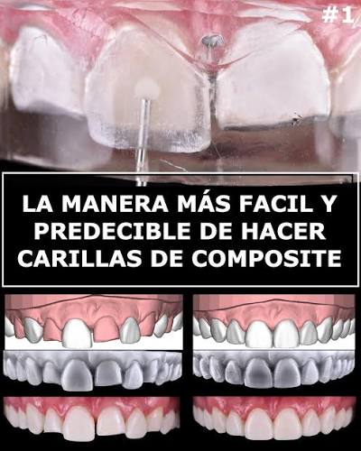carillas inyectables comoposite