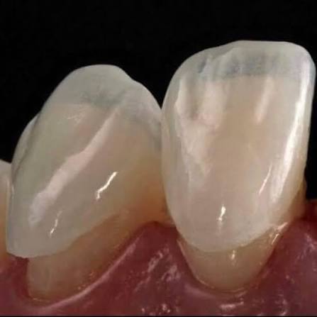 Carillas ultrafinas y no-prep en casos seleccionados