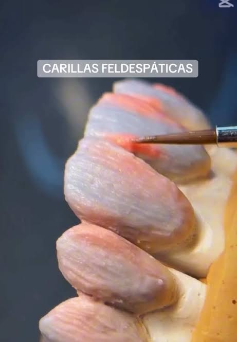Carillas feldespáticas estratificadas de aspecto natural