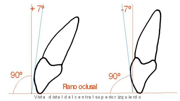 Ortodoncia invisible antes de carillas para preservar esmalte
