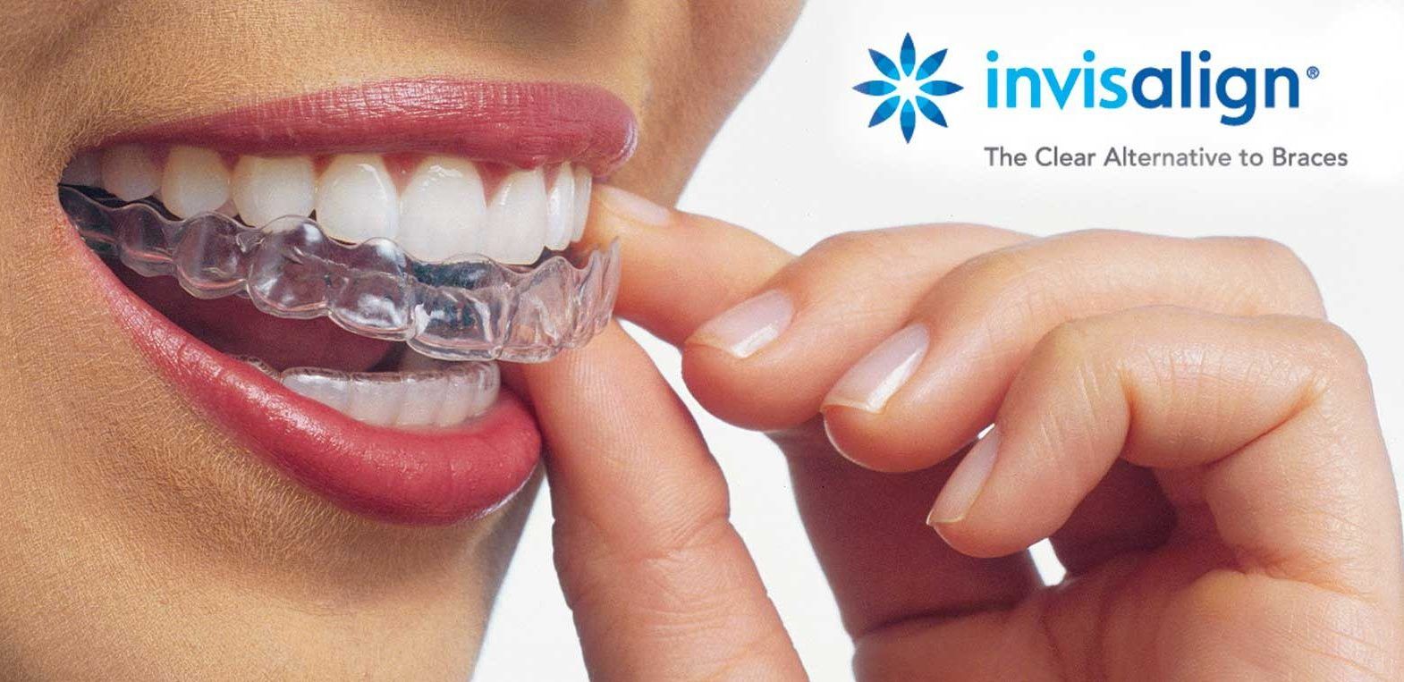 Invisalign antes de carillas: cuándo es necesario y por qué puede hacer el tratamiento más conservador