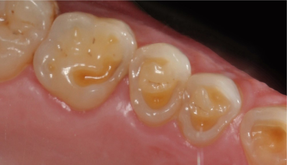 Planificación de sonrisa natural sin tallado dental innecesario