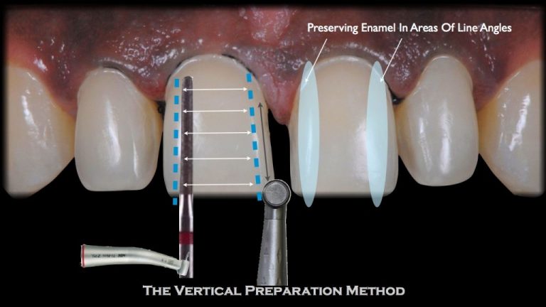 Diseño de sonrisa con mínima preparación dental en SMITA